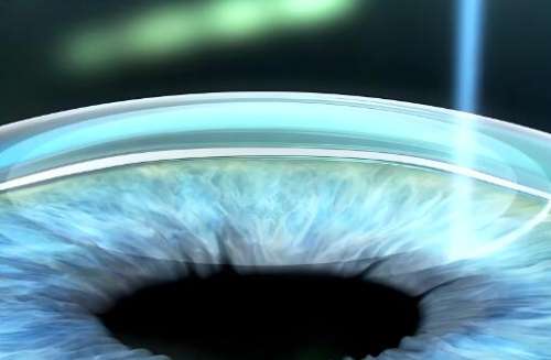 什么是全飛秒手術近視？項目原理，費用明細公布